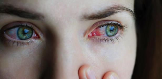 Allergic Conjunctivitis Symptoms