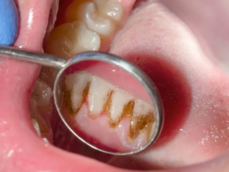 Gum Disease and Everyday Factors That Influence Oral Health&nbsp;Awareness