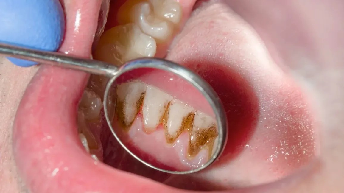 Gum Disease and Everyday Factors That Influence Oral Health&nbsp;Awareness